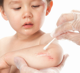 幼儿表皮擦伤的处理